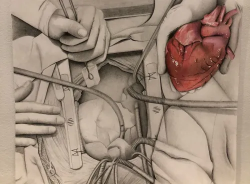 Drawing of a heart transplant operation