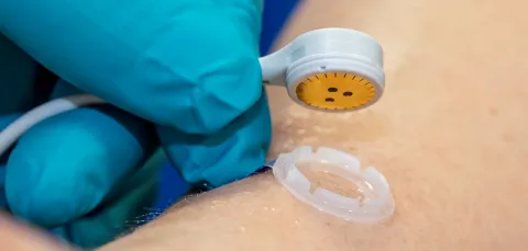 Close up of a skin sensor being placed on a patient's arm