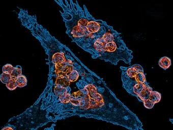 Cancer cells under a microscope