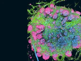 Oesophageal cancer associated fibroblasts