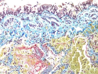Microscopic view of a stained tissue section with purple, blue, yellow, and red areas.