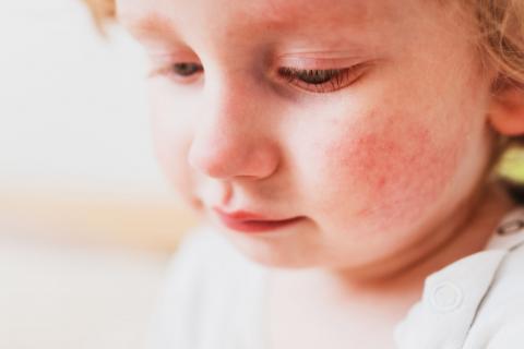 A close-up stock image of a young child with an outbreak of eczema on her cheek.