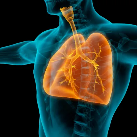A medical illustration showing the upper body of a person with the lungs highlighted in orange. The trachea, bronchi and branching airways are visible inside the ribcage.