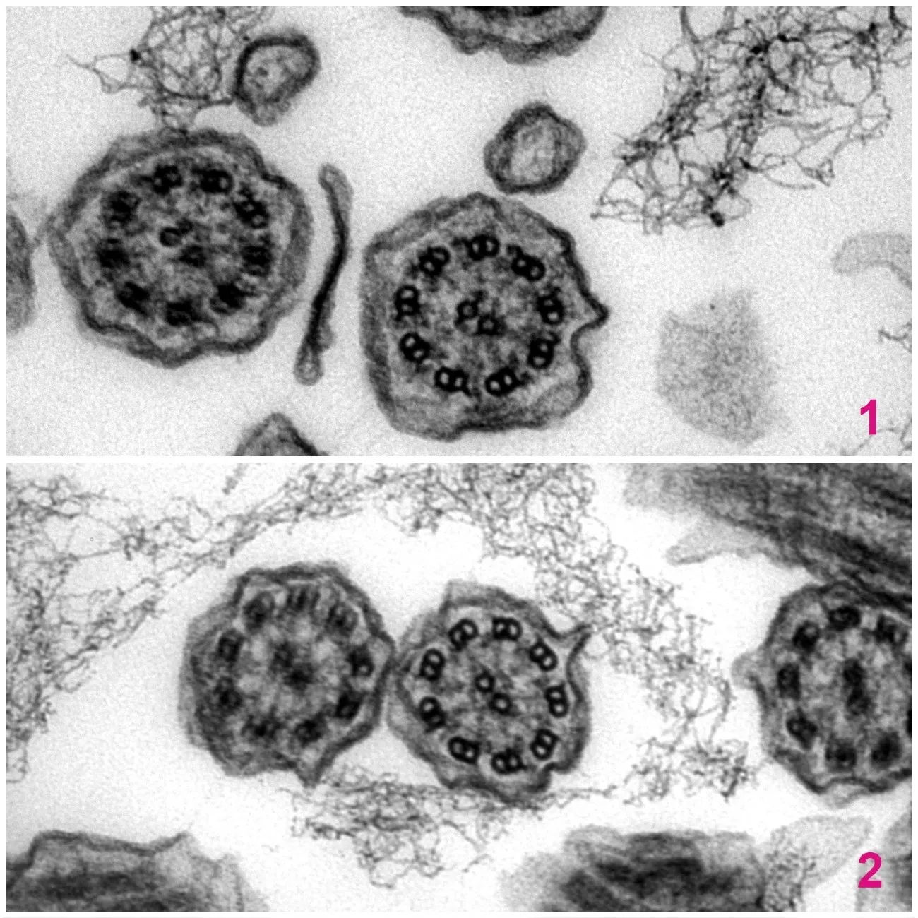 1. A transmission electron microscope image of a single healthy cilium in cross section. The axonemal structure of microtubules is correct and the dynein arms are present. 2. A transmission electron microscope image of a single cilium in cross section from a patient with Primary Ciliary Dyskinesia. The axonemal structure of microtubules is correct however the dynein arms are absent.